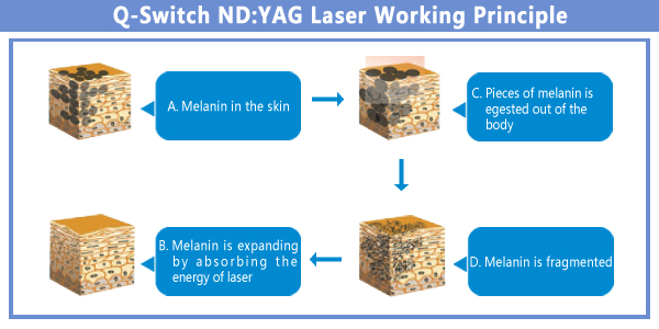 yag laser working principle